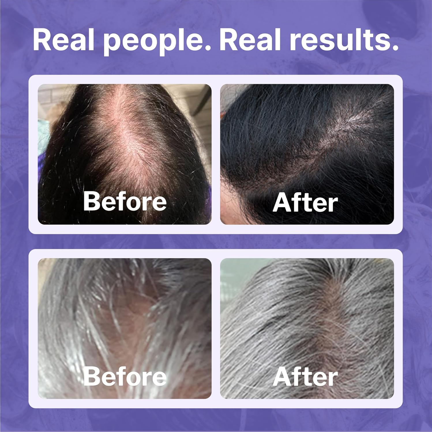 Women's Hair Regrowth Kit with Shampoo, Conditioner, 2% Minoxidil and Leave-In Foamer E11855